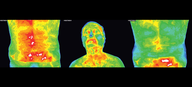medical thermography